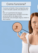 Kit removedor de verrugas